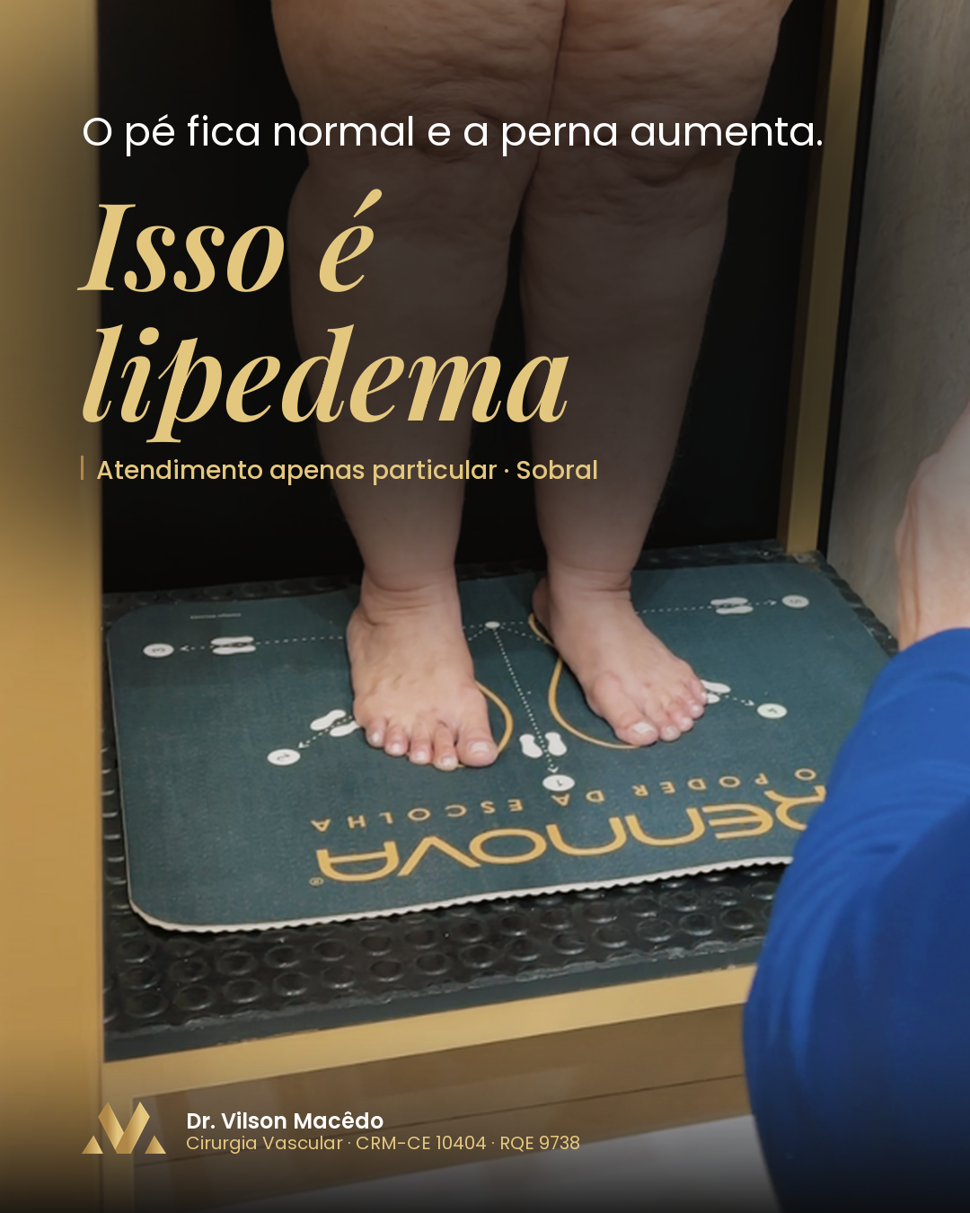 O pé fica normal e a perna aumenta. Isso é lipedema.